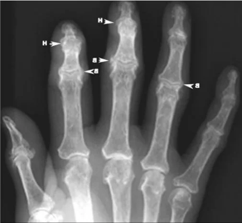 Osteophytes in osteoarthritis of the finger joints on x-ray