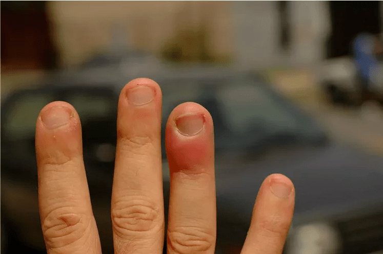 Panaritium periungual, causing pain in the finger joints