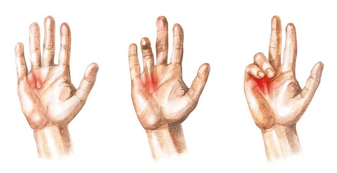 Stage of Dupuytren's contracture - inability to straighten the fingers