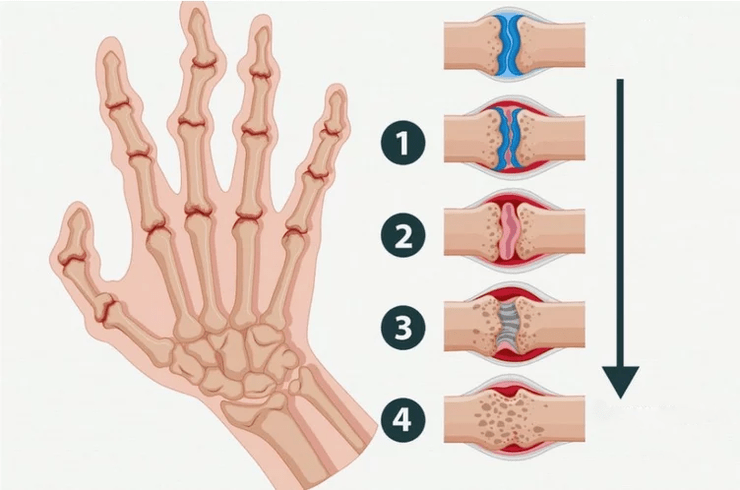 Stages of rheumatoid arthritis affecting finger joints