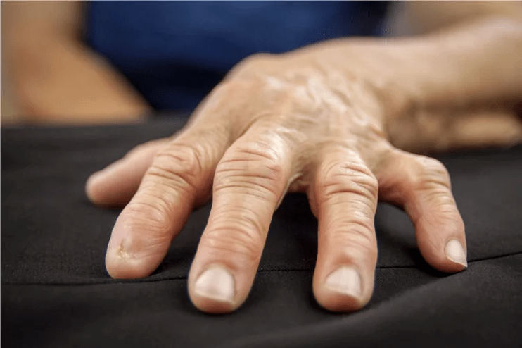 With gout, the knuckles are warm to the touch, swollen, and painful. 