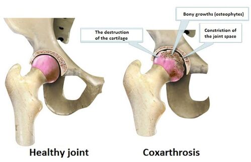 Healthy joints affected by chocolate joints