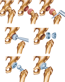 Installation of endoprosthesis