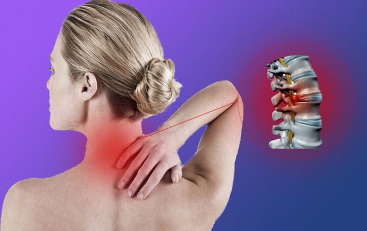 Inflammation of the spinal cord with cervical osteochondrosis