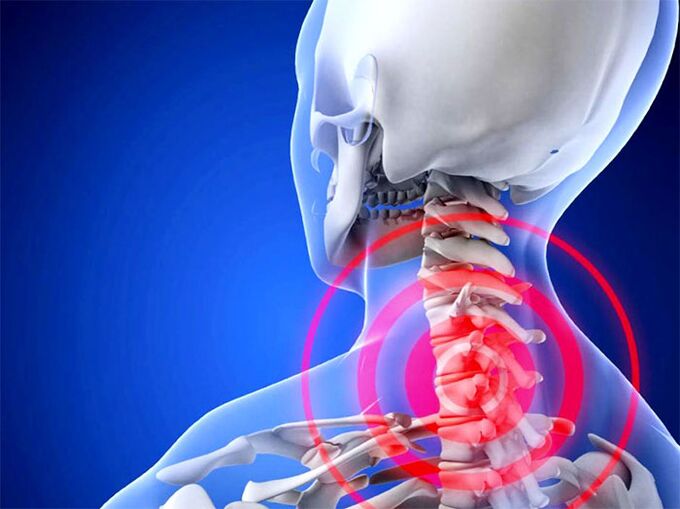 The cervical region that is inflamed