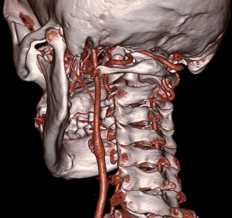 artery pinching with cervical osteochondrosis