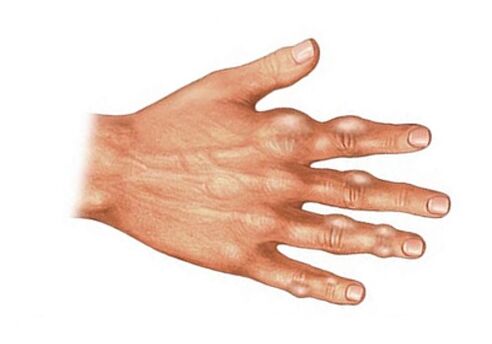 Deposition of uric acid crystals in soft tissue in gout