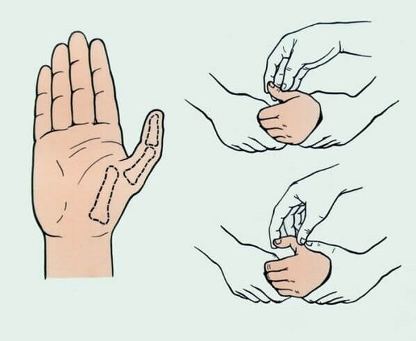 Reduction of dislocated fingers, necessary to eliminate joint pain