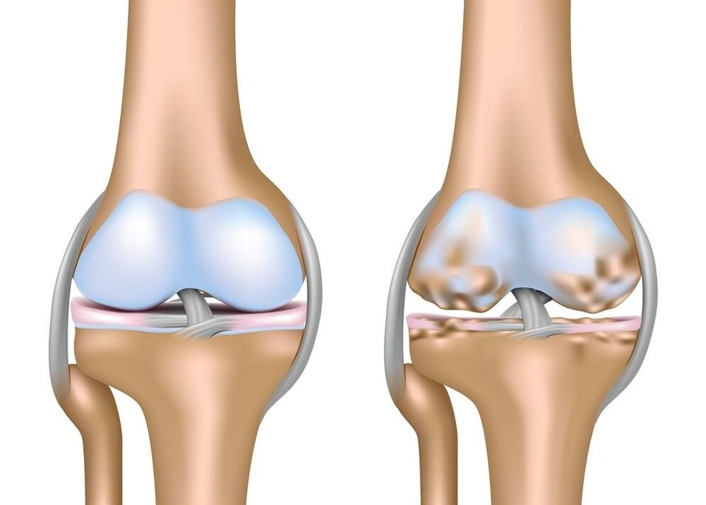 exacerbation of joint arthrosis