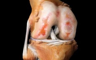 What is knee arthrosis
