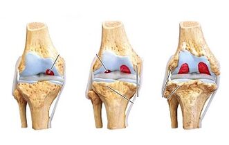 stage of development of arthrosis of the knee joint