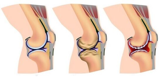 healthy joints and pain due to the destruction of the knee joint