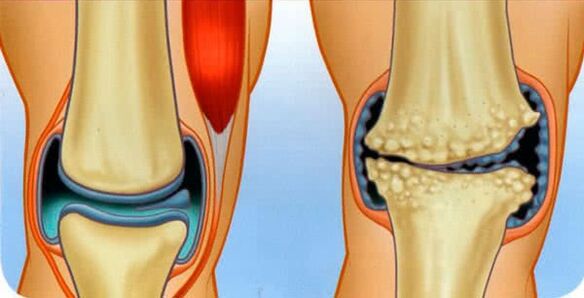 healthy joints and joint arthrosis