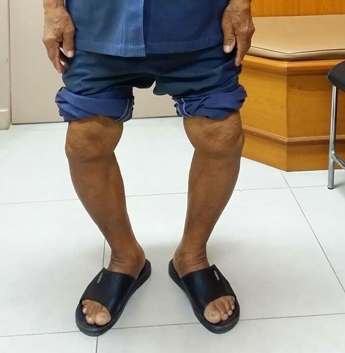 deformed knee joint with arthrosis