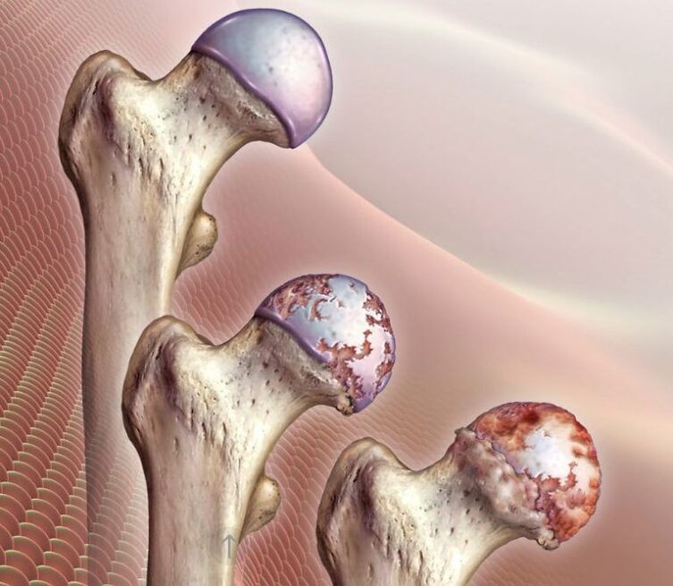 Arthrosis of the hip joint in various stages