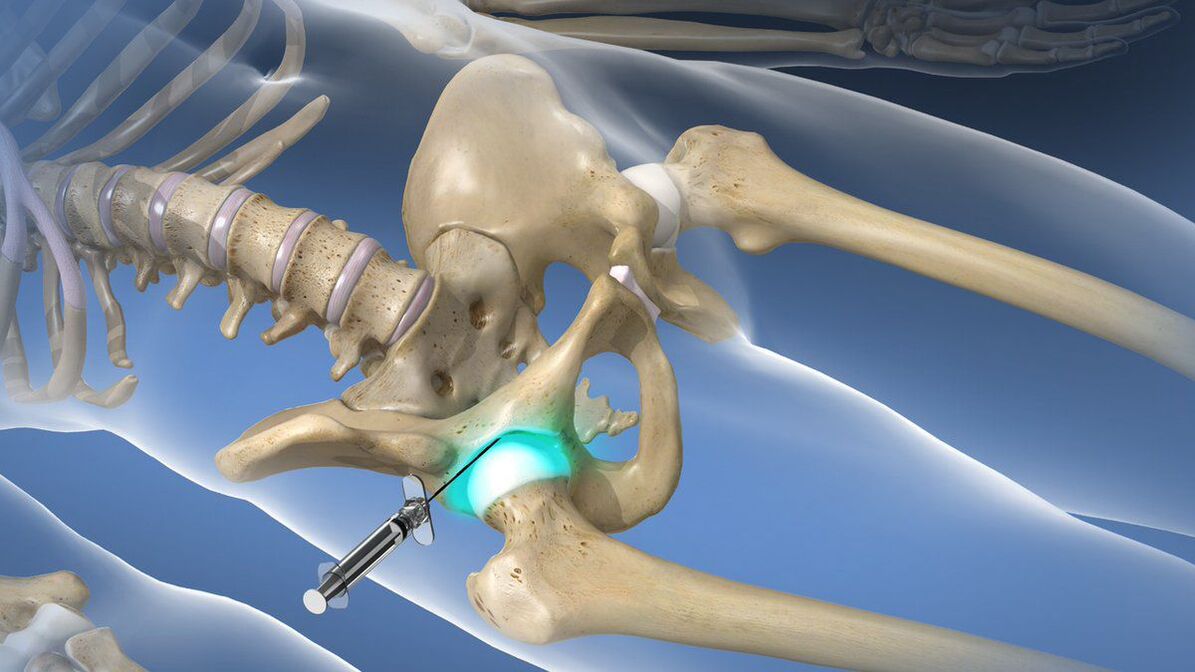 Intra-articular blockade for severe pain accompanying hip arthrosis