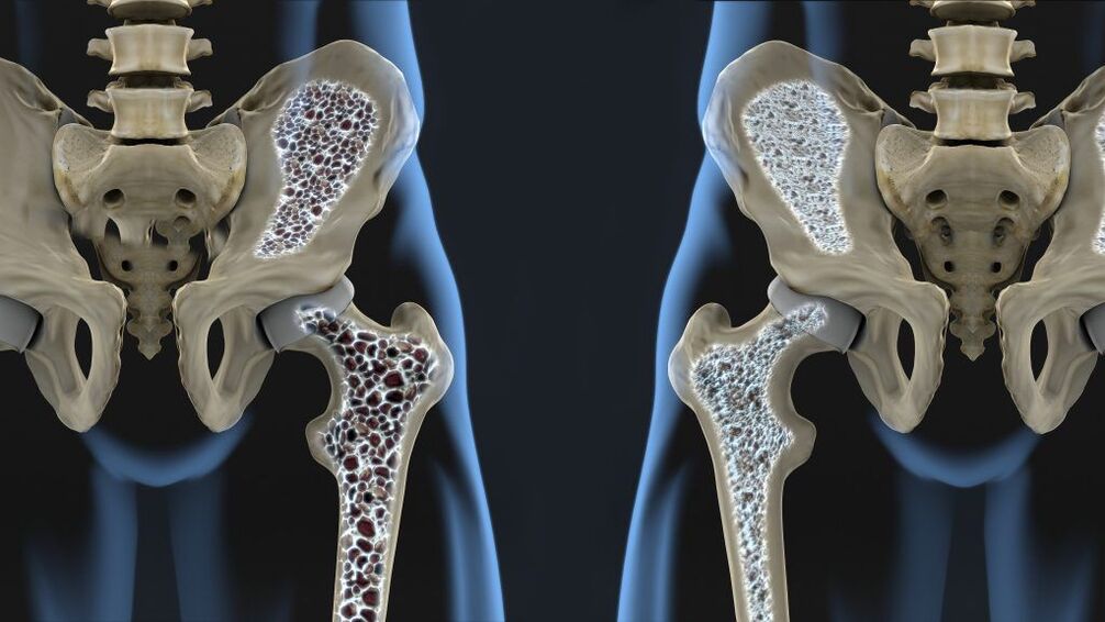 Osteoporosis is a leading cause of hip fractures and hip arthrosis