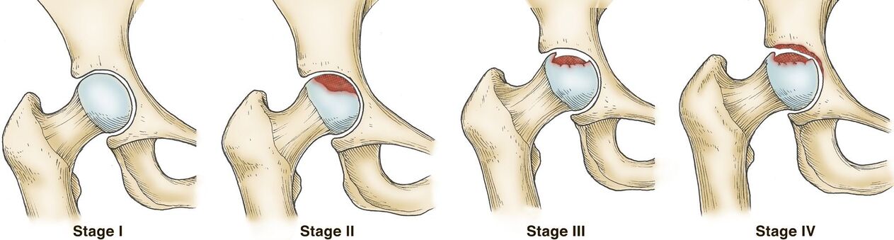 Stages of arthrosis of the hip joint