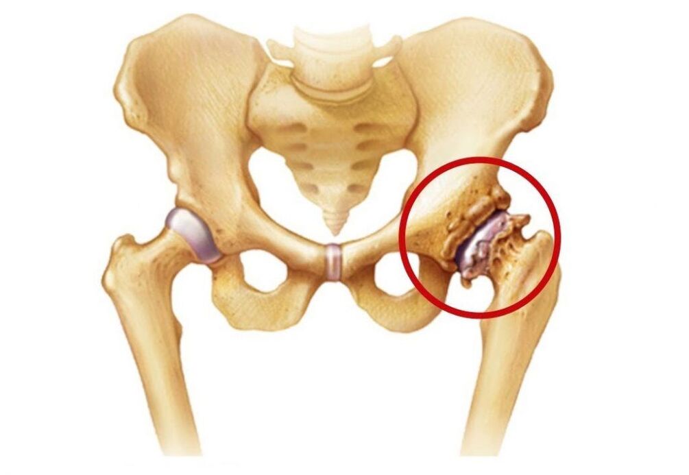 The hip joint is affected by arthrosis