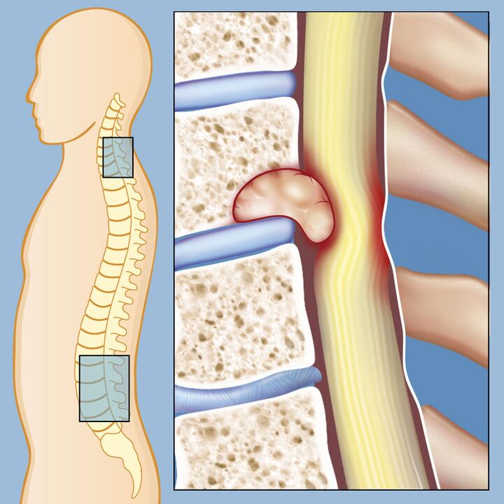 Malignant tumors as a cause of severe low back pain